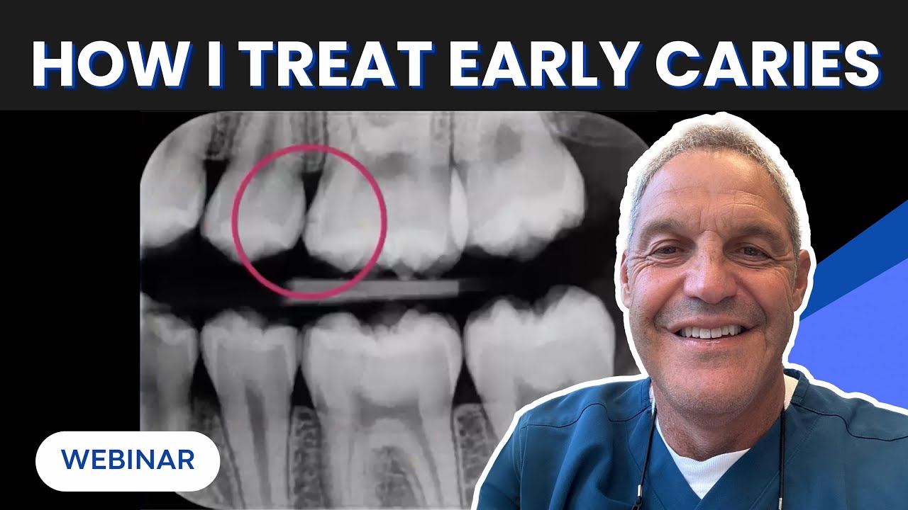 How I Treat Early Caries With Curodont™