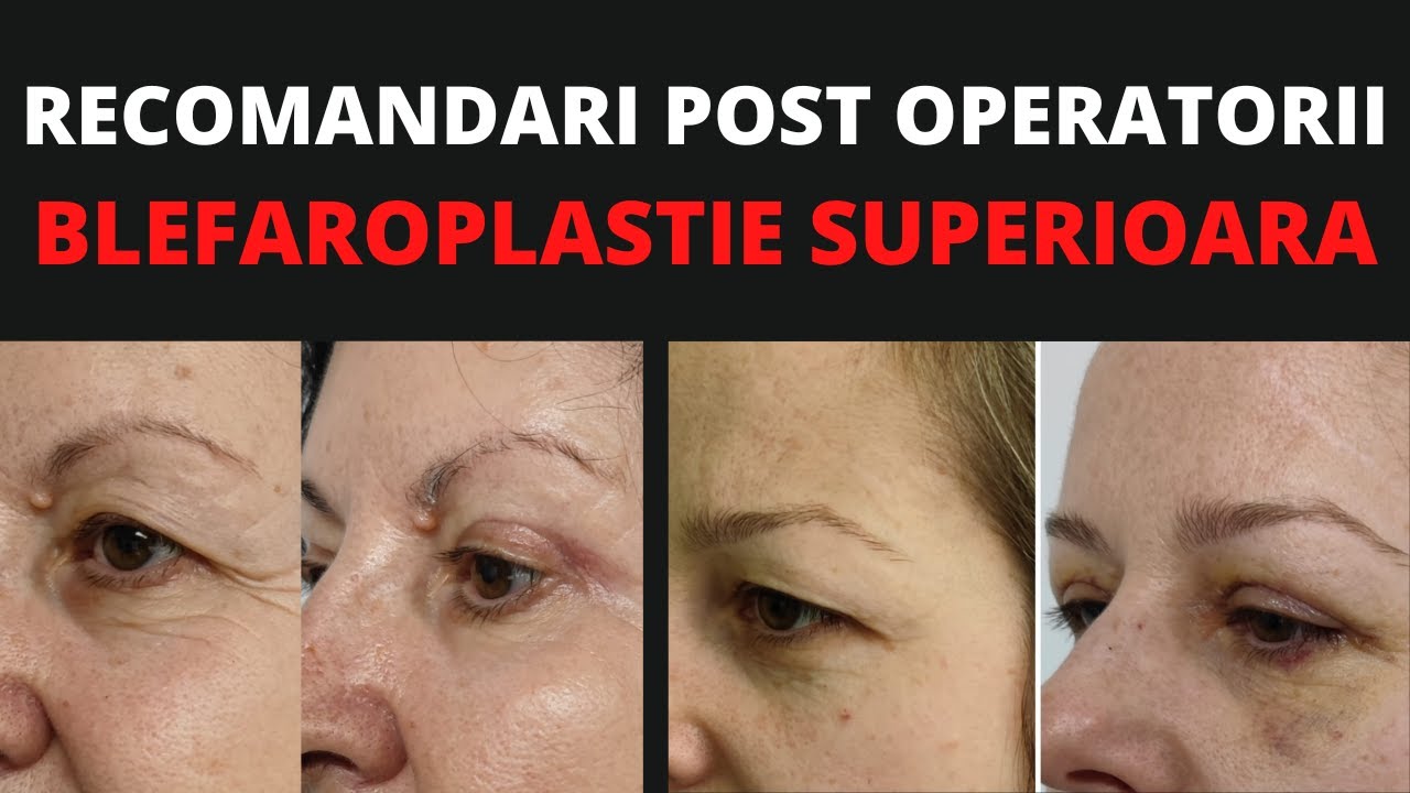 Recomandari Post OPERATORII - BLEFAROPLASTIE SUPERIOARA