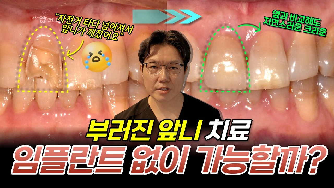 앞니 부러졌을 때 확인해야 할 3가지 체크리스트 | 치아 외상 신경치료 크라운 케이스