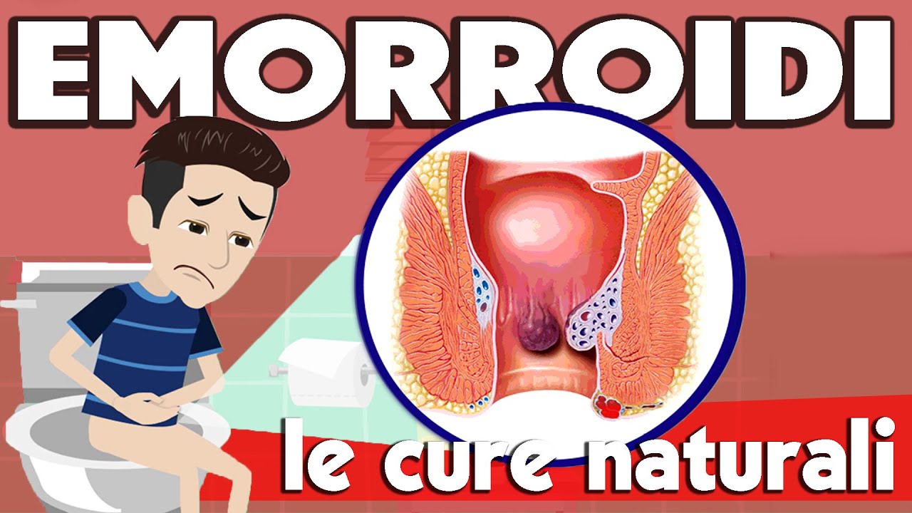 EMORROIDI interne ed esterne - sintomi, cause e come curarle in modo NATURALE