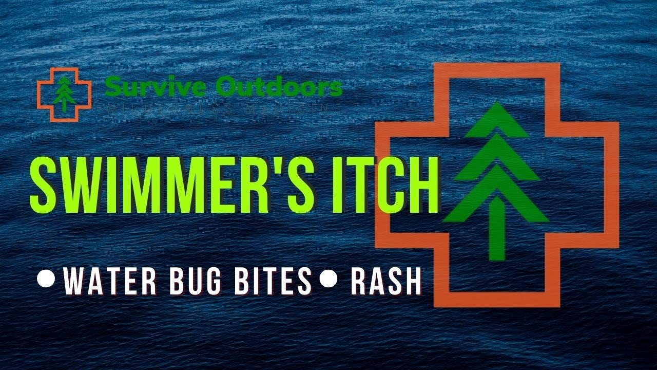 Water Bug Bites - Swimmers Itch vs Sea Lice