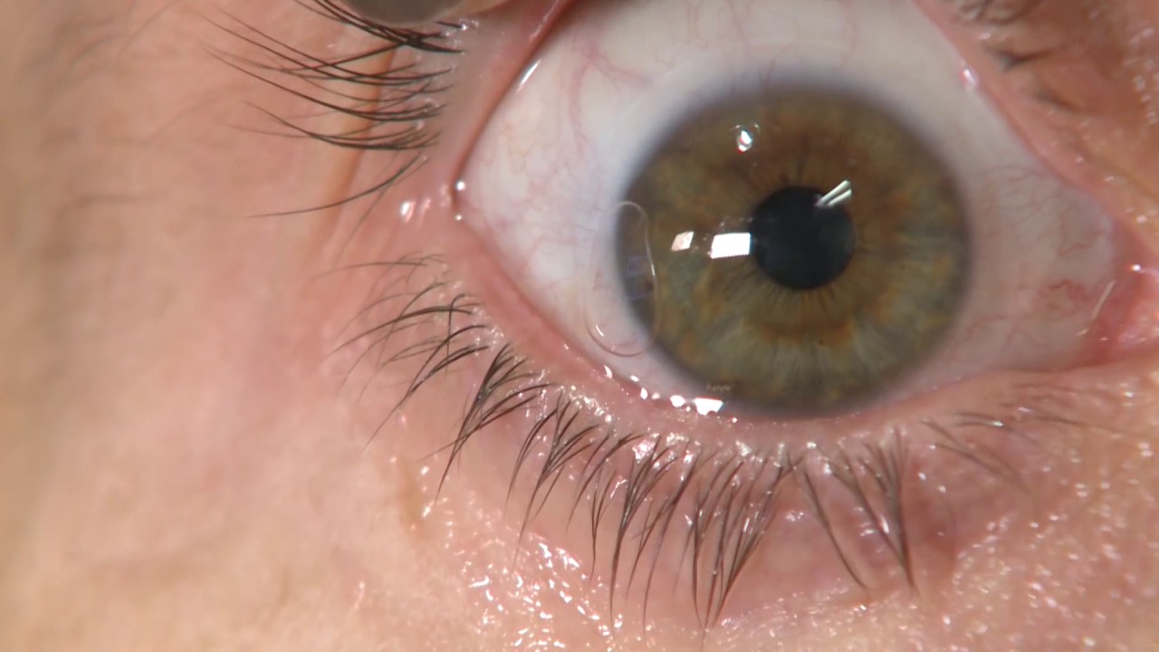 FUNGAL KERATITIS: CONTACT USERS LOOK OUT!