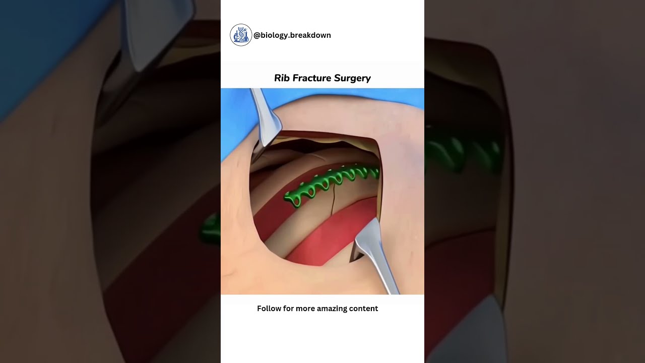 Rib Fracture Surgery  #biologybreakdown #ribfracture