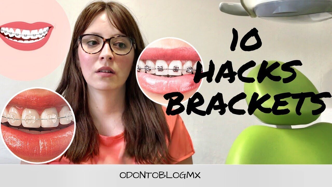 10 Hacks/tips para los que tienen brackets