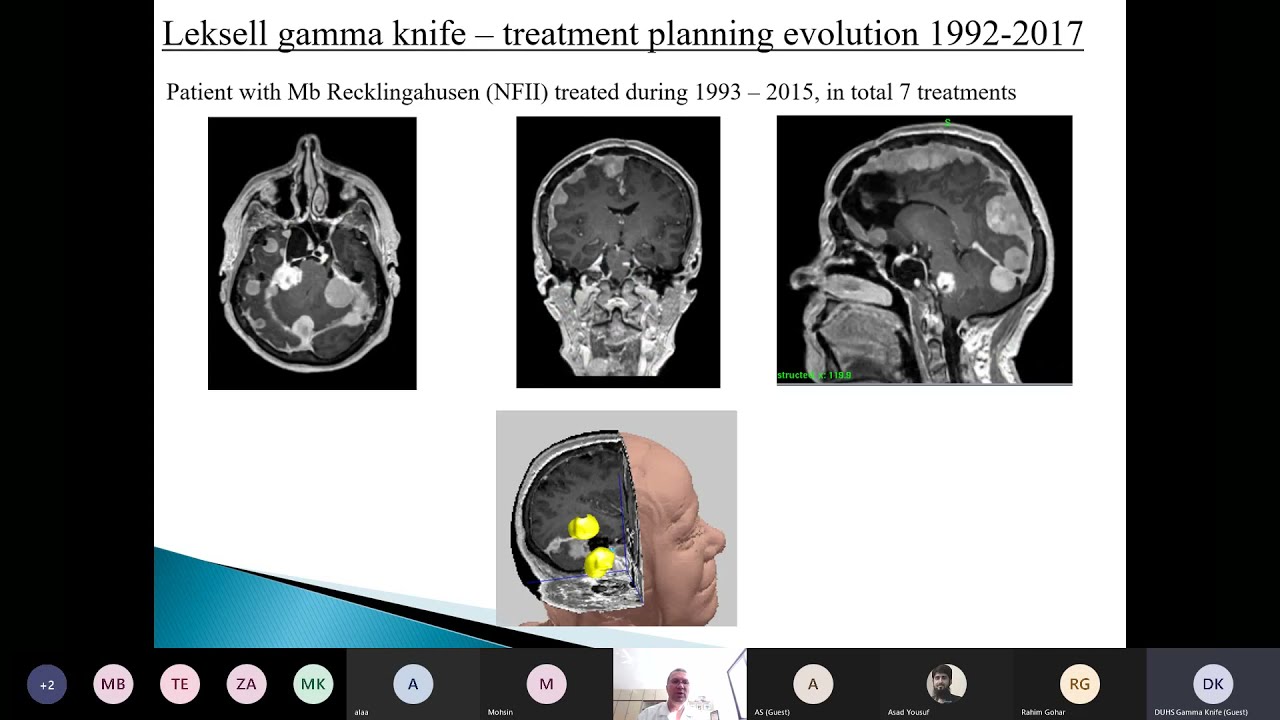 Evaluation of Lekswell Gamma Knife 30 Years of Experience
