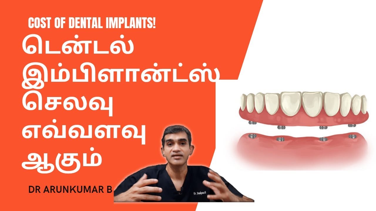 டென்டல் இம்பிளான்ட் விலை | தமிழில் Cost of Dental Implants | Dr Arunkumar Pearls Dentistry Chennai |
