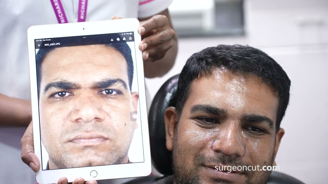 Male Rhinoplasty Surgery in India - Complete Before & After Recovery Results