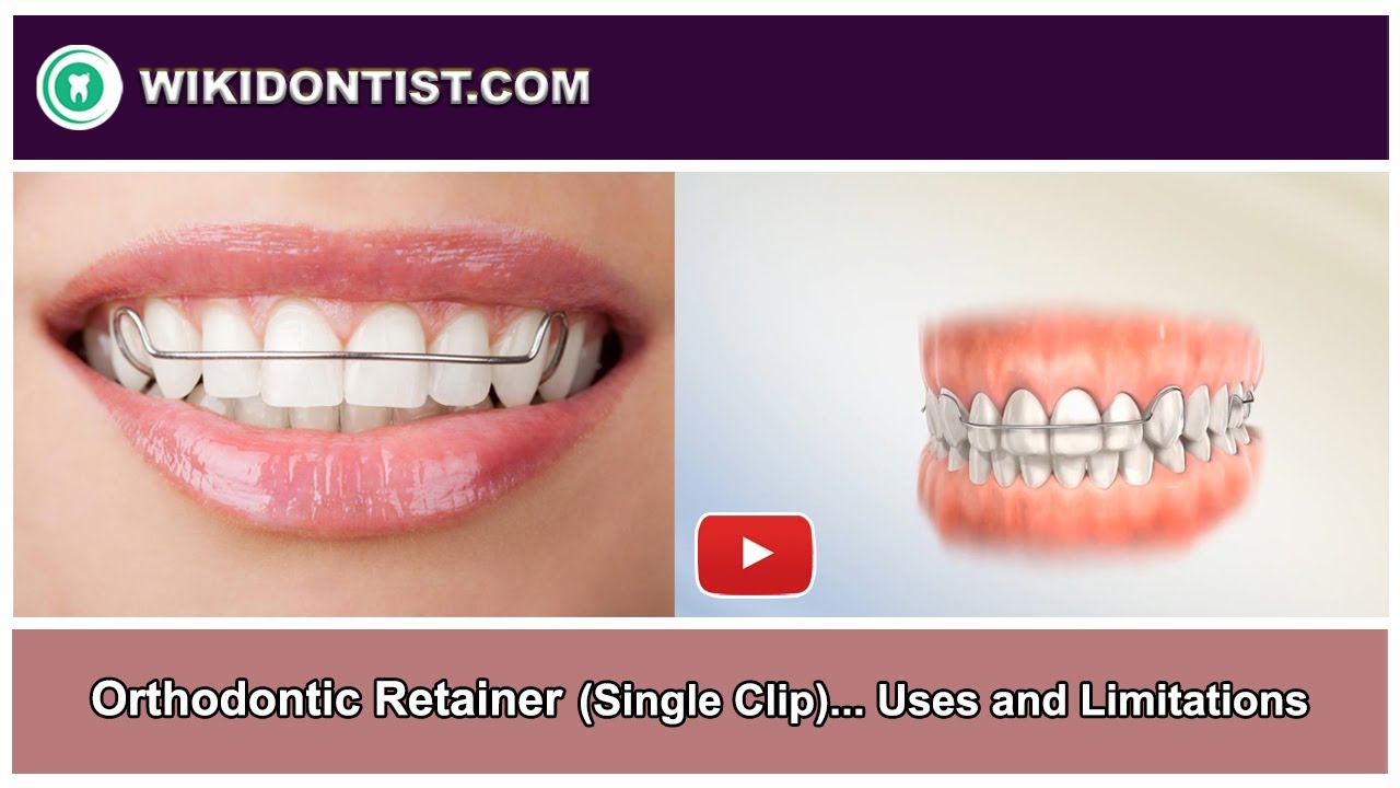 Orthodontic Retainer Uses and Limitations