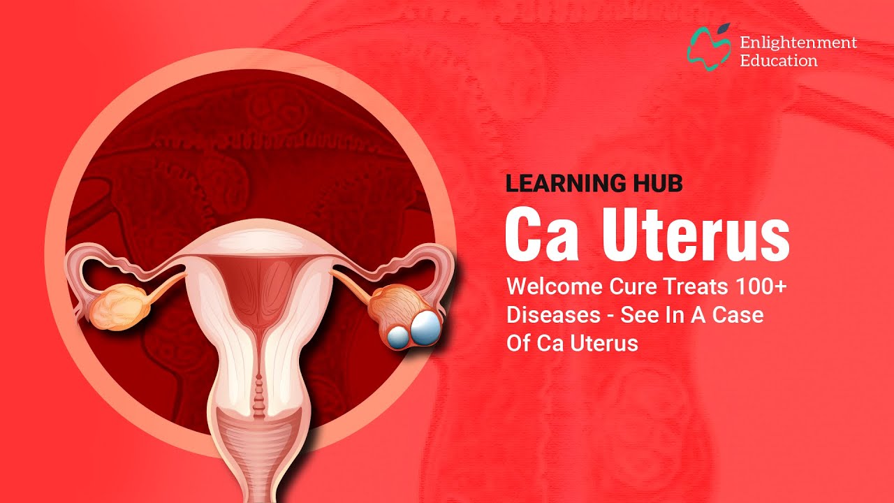 Learning Hub || Homeopathic Case Study - 10. Case of Cancer of Uterus - Homeopathic Remedy Calcarea