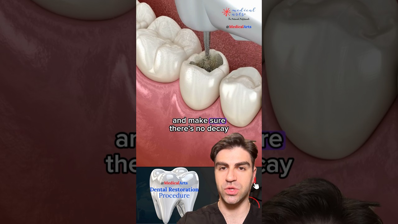 Tooth Filling: A Fun Animated Overview!