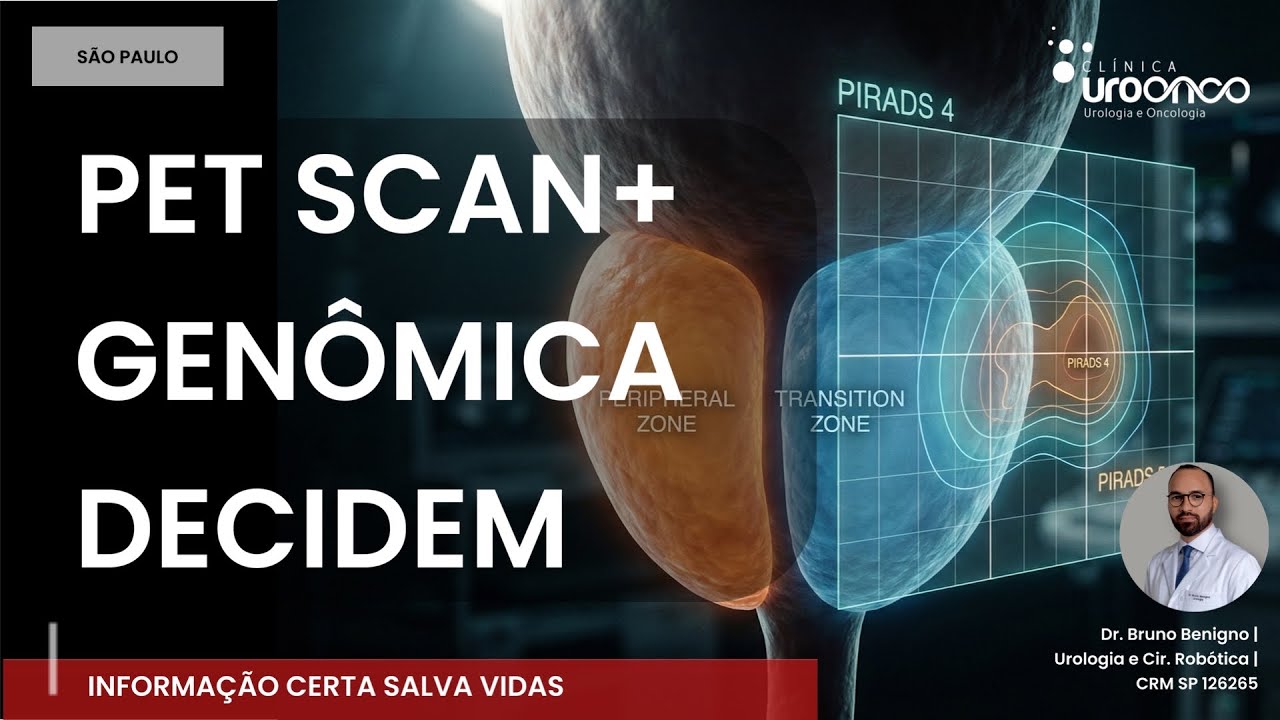 PSA baixo, PI-RADS 4 e Gleason 3+4: CIRURGIA ou VIGILÂNCIA ATIVA?
