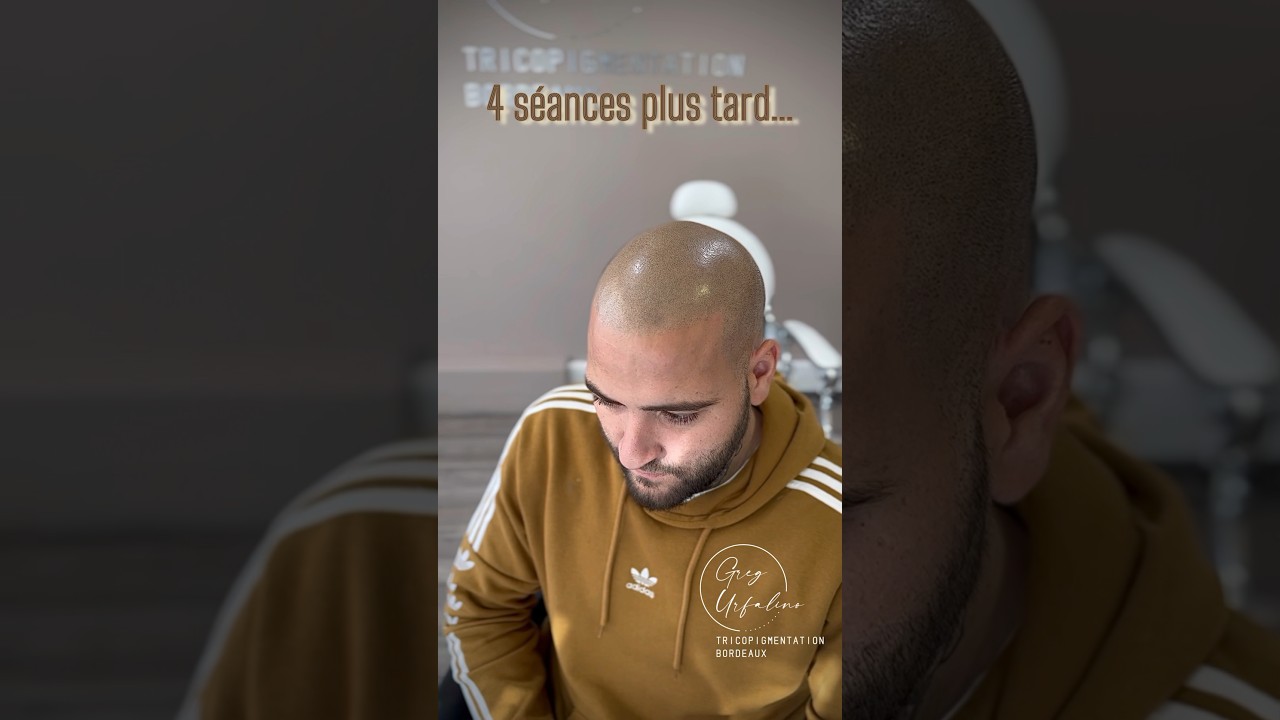 #tricopigmentation #tricopigmentationbordeaux #dermopigmentation #bordeaux #micropigmentation #reels