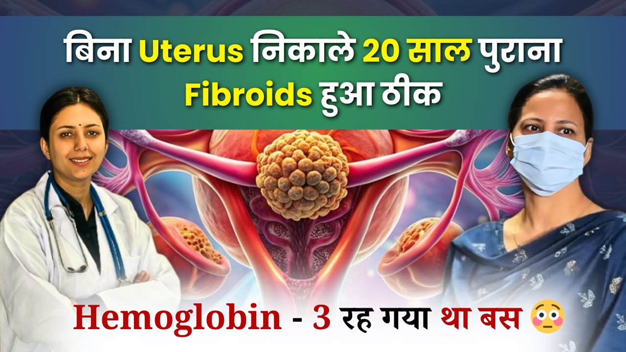 बच्चेदानी में 20 साल पुरानी रसौली का इलाज बिना Uterus निकाले | Fibroids 100% Treatment | Dr. Upasana