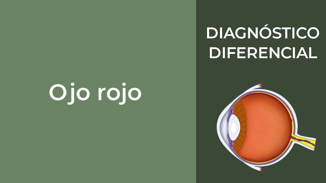 Ojo rojo. Diagnóstico diferencial