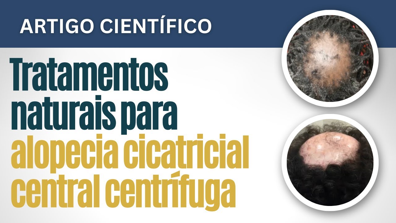 Alopecia cicatricial central centrífuga e propostas de tratamentos naturais