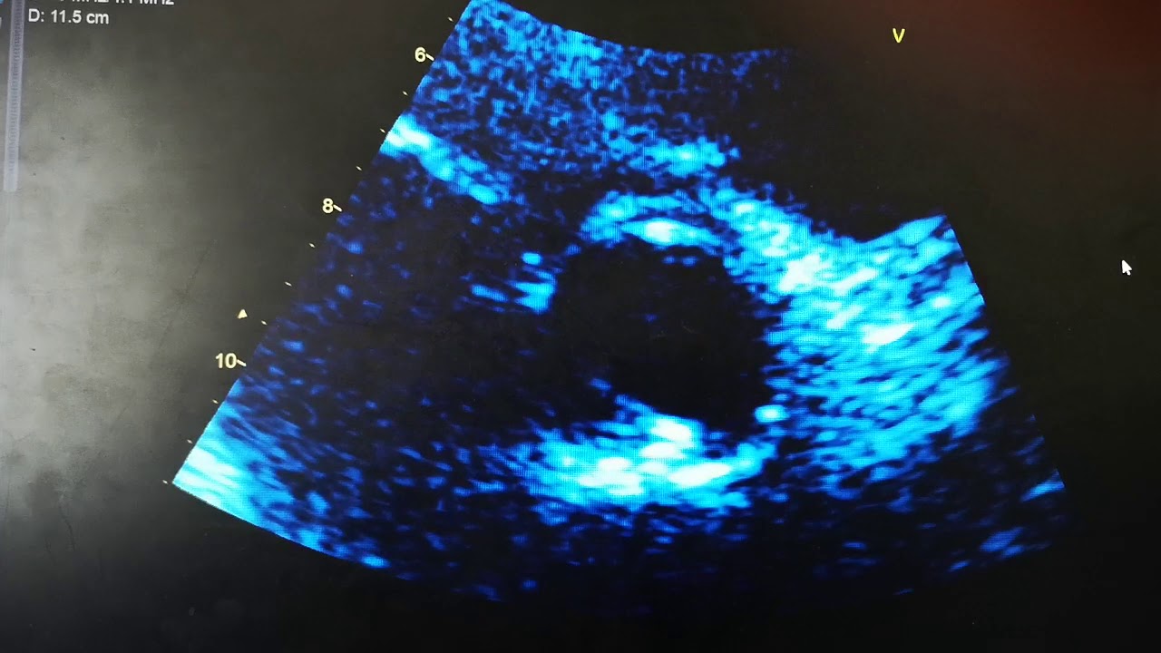 Bicuspid Aortic Valve Transthoracic Echocardiography
