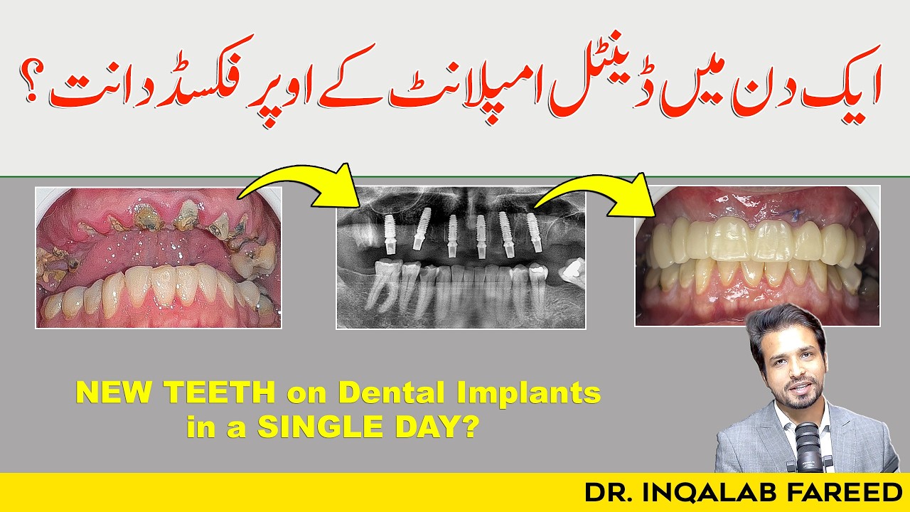 Get NEW TEETH on Dental Implants in Just 24 Hours in Pakistan | @Dr. Inqalab Fareed