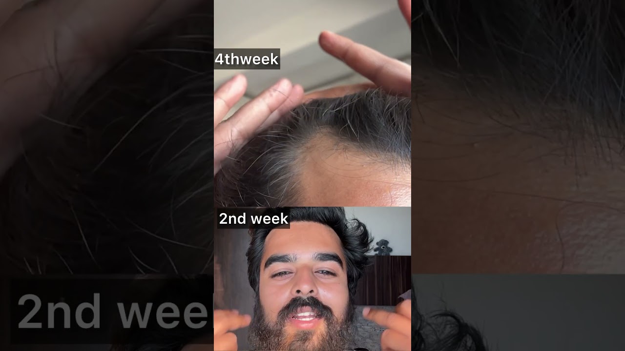 4weeks of Jamalgota oil results #hairfall #alopecia