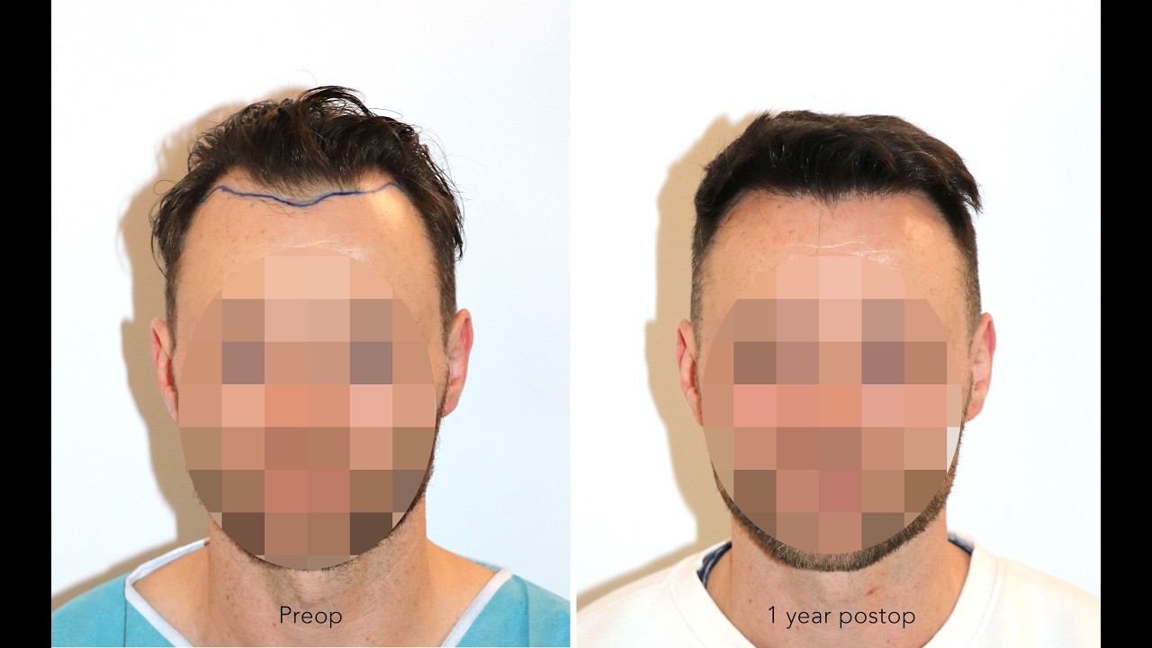Haartransplantation Geheimratsecken & zurückgewichene Haarlinie | 2285 FUs | FUE | Dr. Feriduni