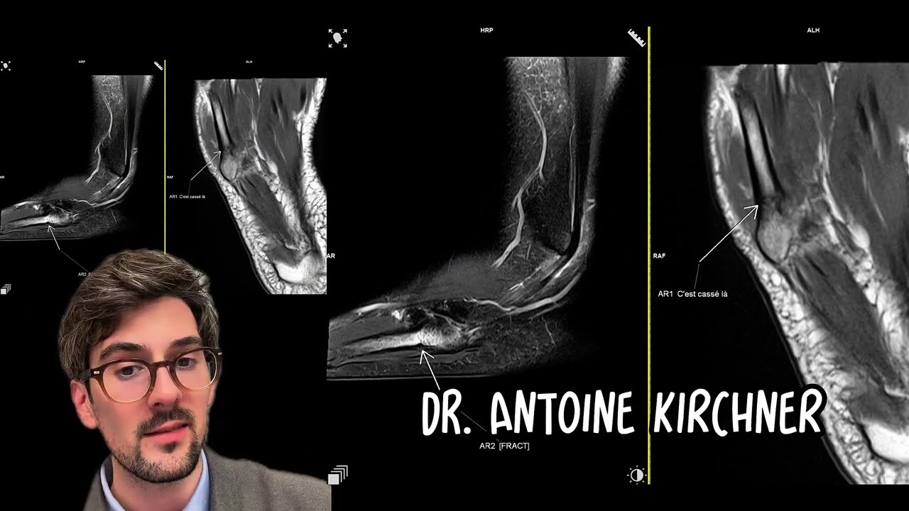 Fracture de Jones =/= fracture de la base de M5 - Radiologue Antoine Kirchner 
