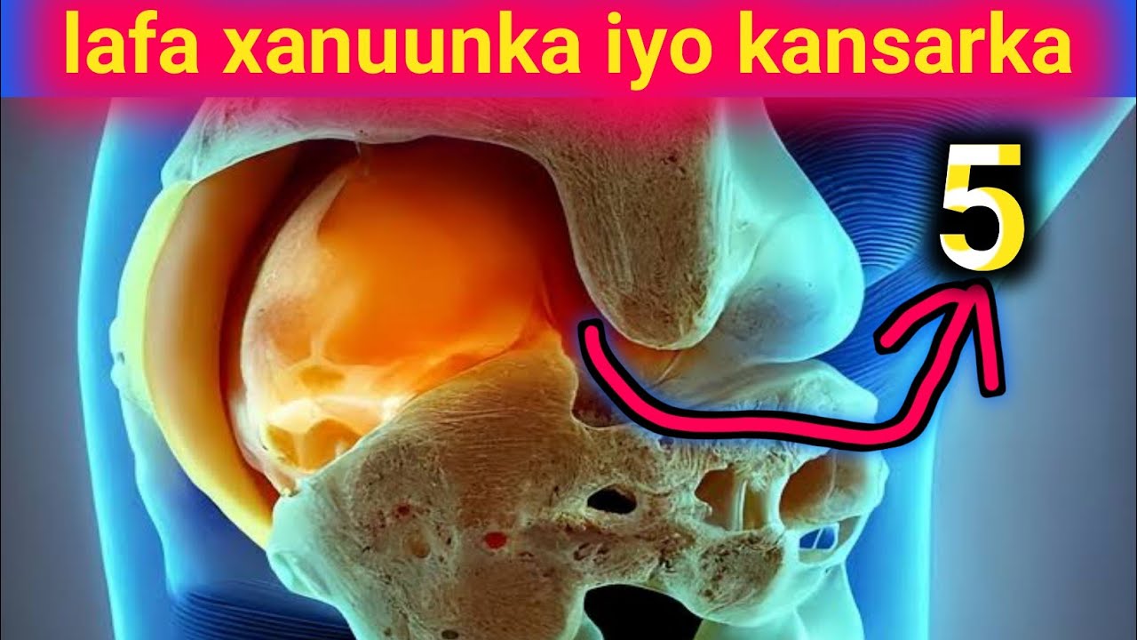 lafa xanuunka iyo kansarka lafaha xiriirka ka dhaxeeyo iyo sida lagu garto marka uu....