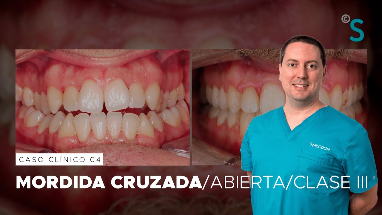 Mordida cruzada · Caso clínico de Ortodoncia