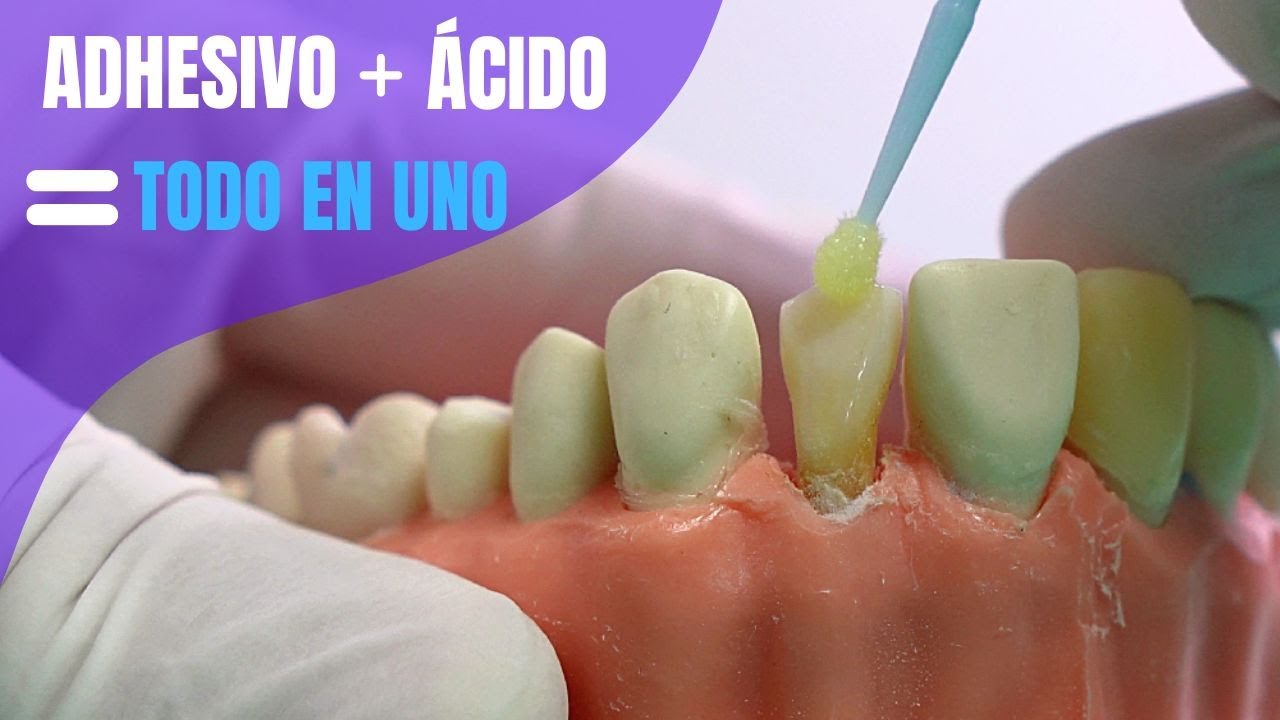Ácido y Adhesivo todo en uno/Adhesivo Universal