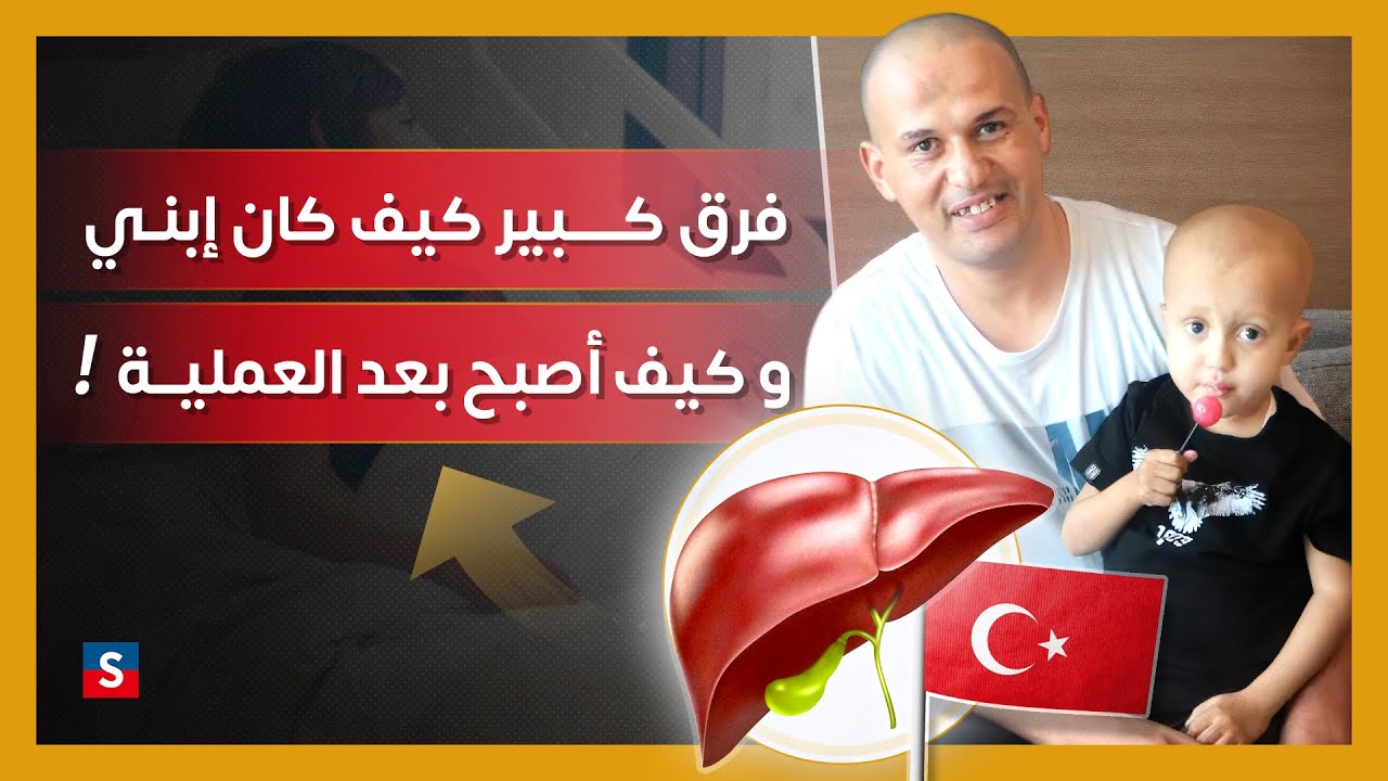 زراعة الكبد للاطفال في تركيا
