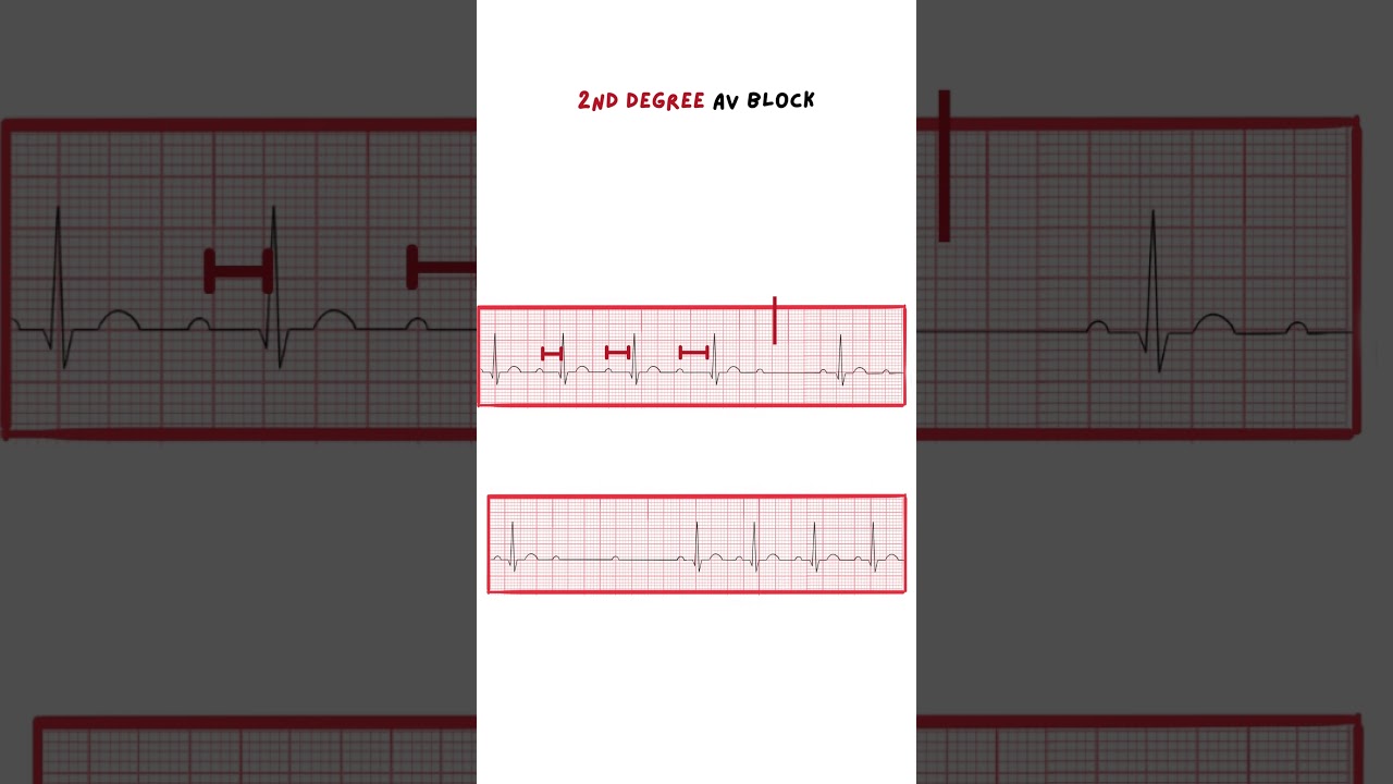 Wenckebach & Mobitz/ 2nd degree AV Block #ecg #medicine #medical #medicalstudent #doctor #nurse