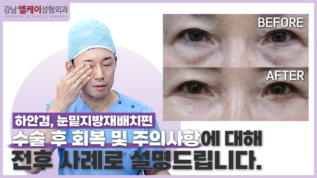 하안검 & 눈밑지방재배치 수술 후, 꼭 알아야 할 주의사항은!