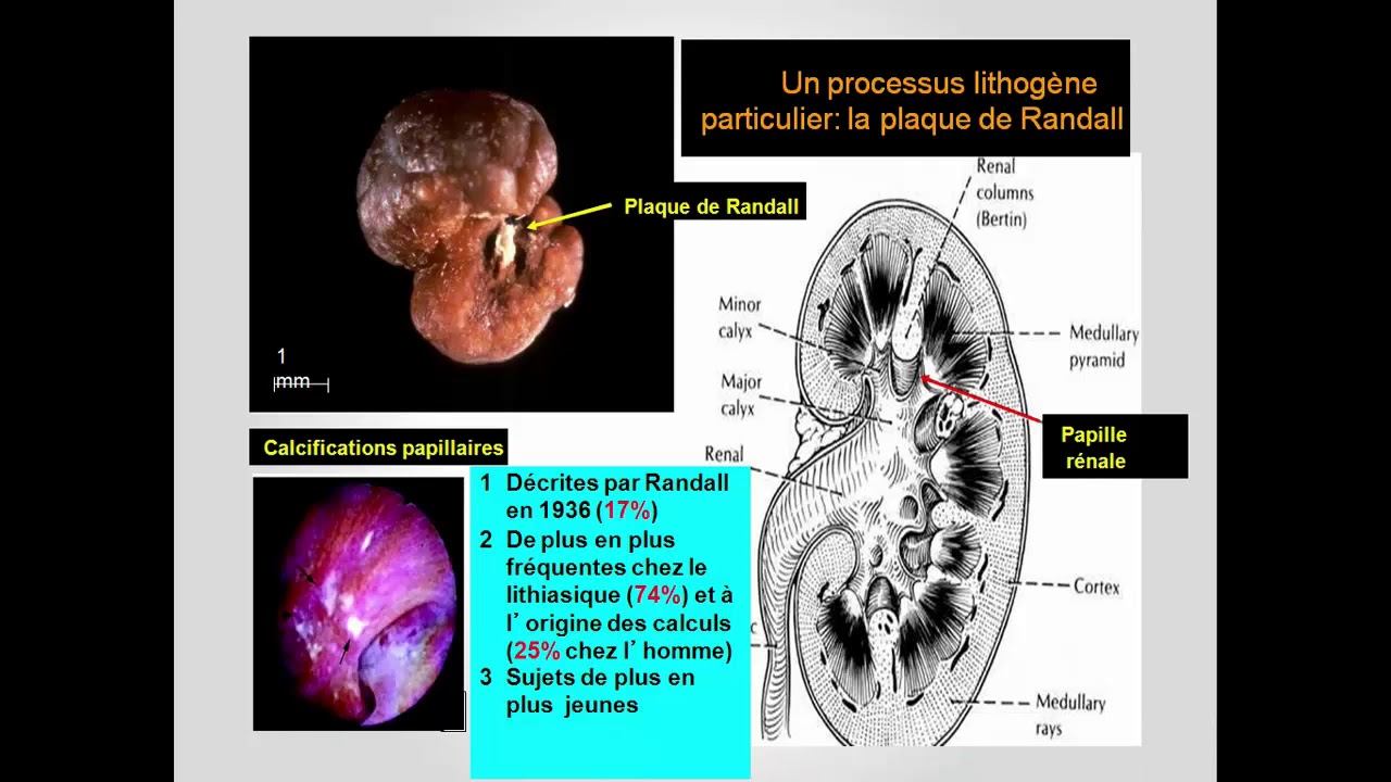 FMPM MOOCs - Lithiase urinaire - Pr. Moudouni