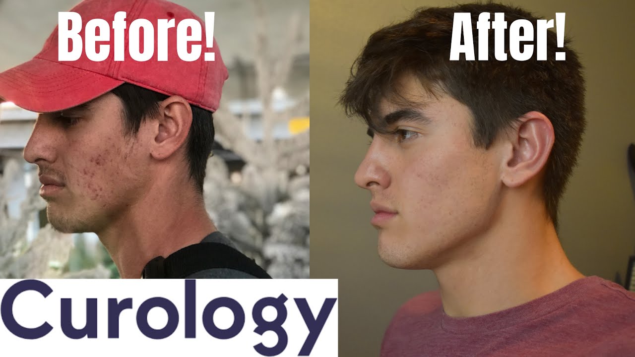 CUROLOGY BEFORE AND AFTER TEST!! (Does it Work?)