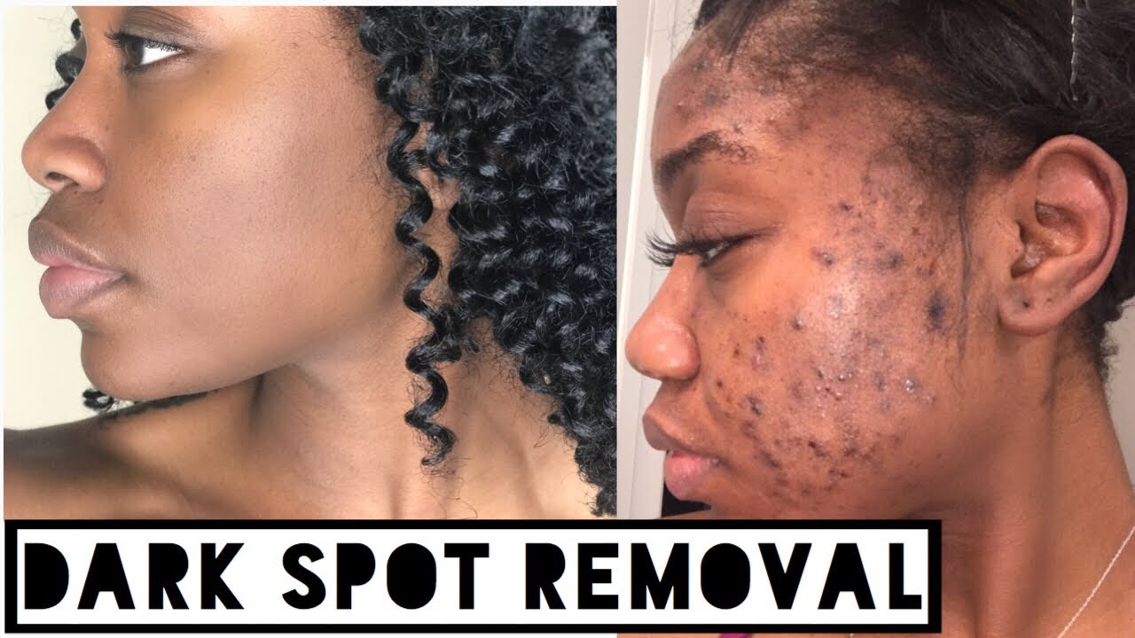 SKIN| How to Get Rid of Dark Scars (Hyperpigmentation) & Acne Scars at Home (No Click Bait)