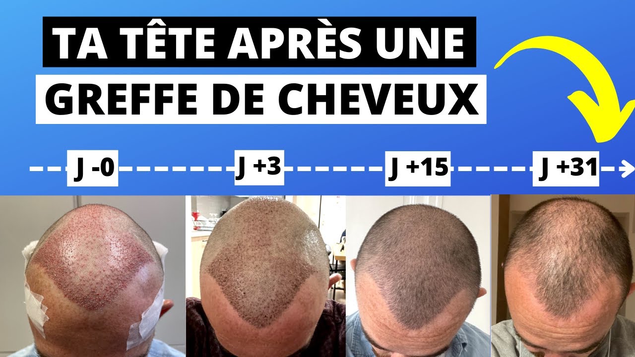 Quelle Tête on a après une Greffe de Cheveux le 1er mois ? Jour par Jour 🎥