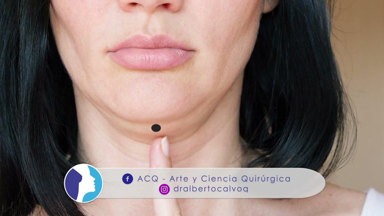 REJUVENECER el cuello FLÁCIDO y ARRUGADO ❤️ CERVICOPLASTÍA  🧣 LIFTING de CUELLO ⭐ Dr ALBERTO CALVO