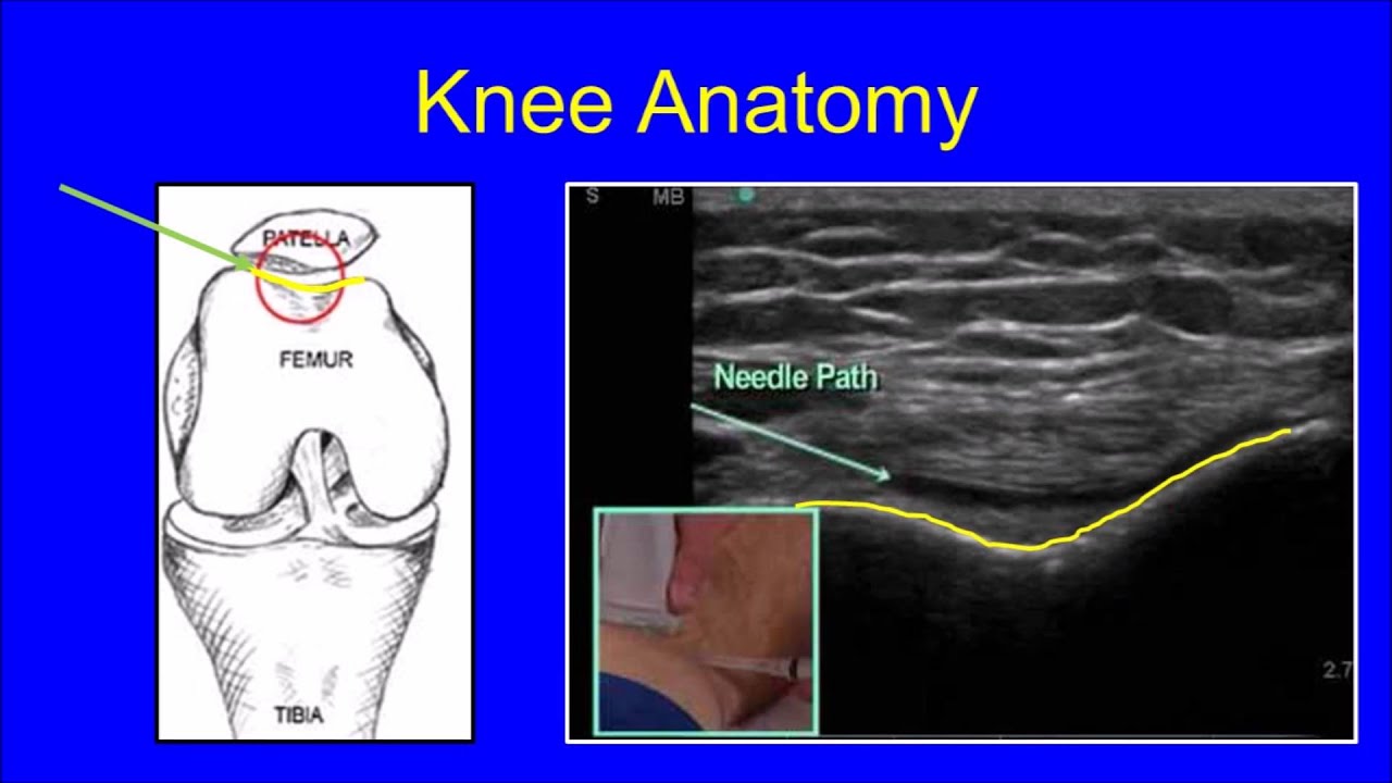 Overview of Ultrasound Guided Injections for Pain Relief
