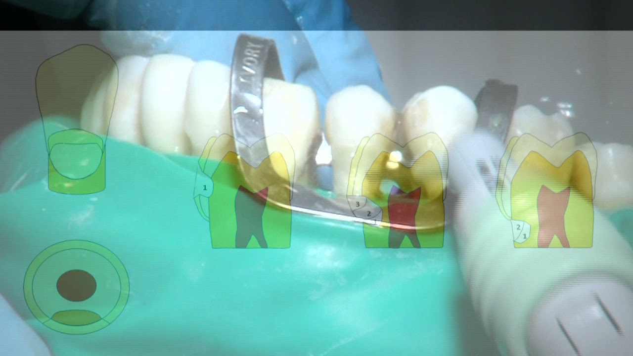 OPERATORIA DENTAL Y ENDODONCIA: TÉCNICAS Y MATERIALES_10. COMPOSITE: CAVIDAD DE CLASE V.