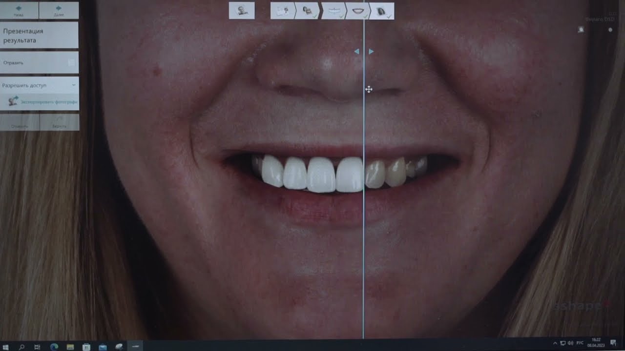 Digital Smile Design или технология &laquo;Цифровой дизайн улыбки&raquo;