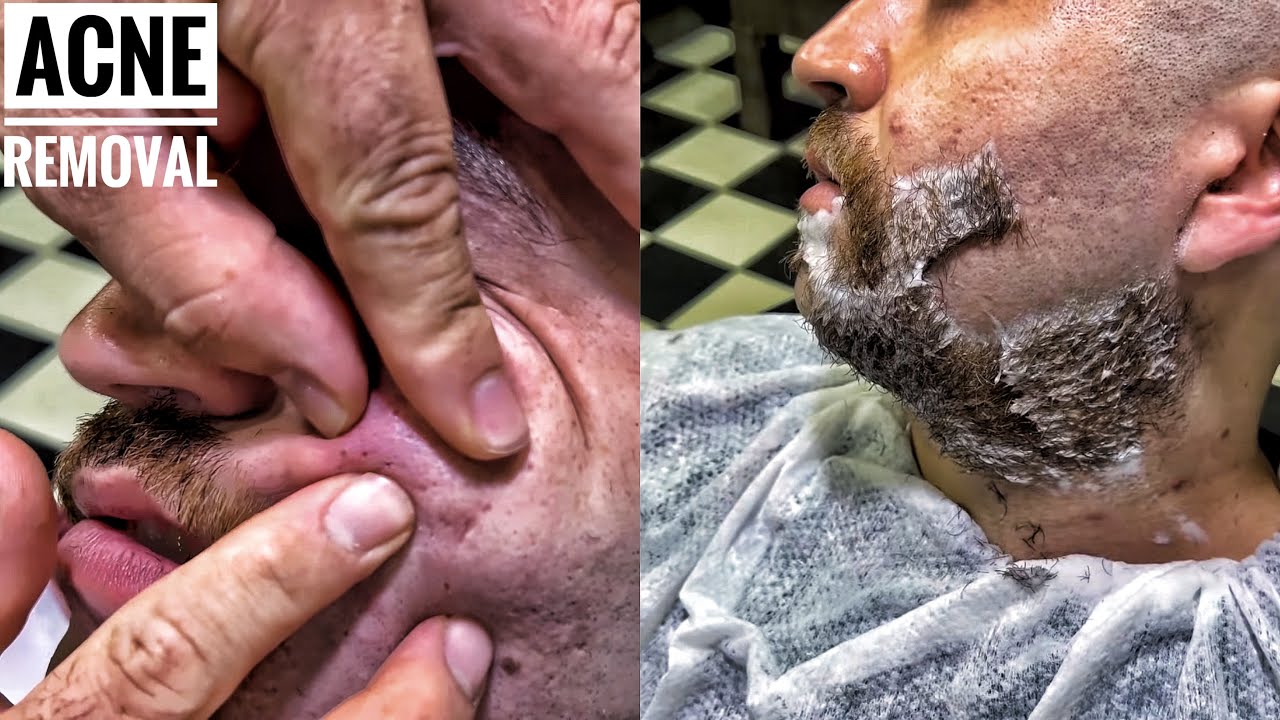 ASMR BEARD CUT • Acne removal and mustache shaving