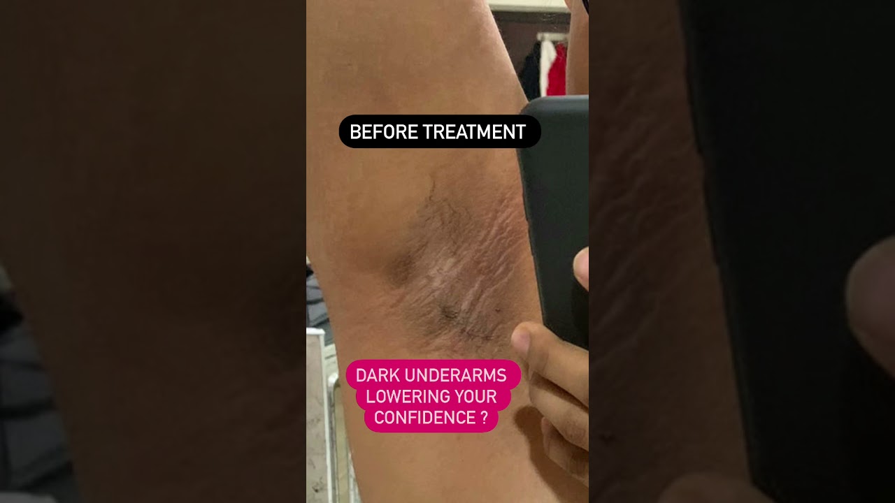 Dark underarms killing your confidence | Dr Ashima Goel| Dermatologist |Chandigarh|Mohali #shorts