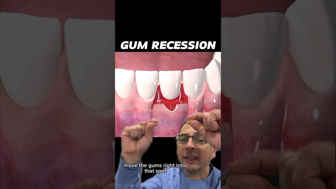 An Invasive Way to Fix Gum Recession | View Mobile Dental #shorts