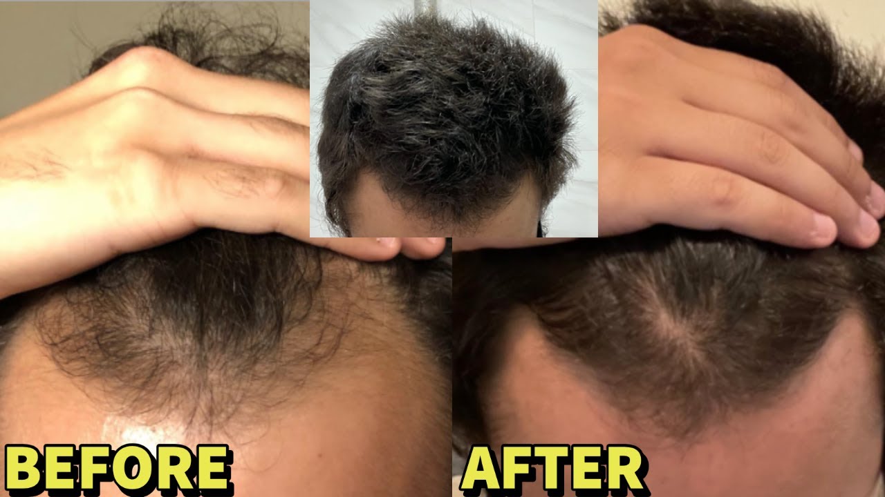 He REVERSED Hair Loss With JUST Dutasteride and Microneedling! UNBELIEVABLE RESULTS!