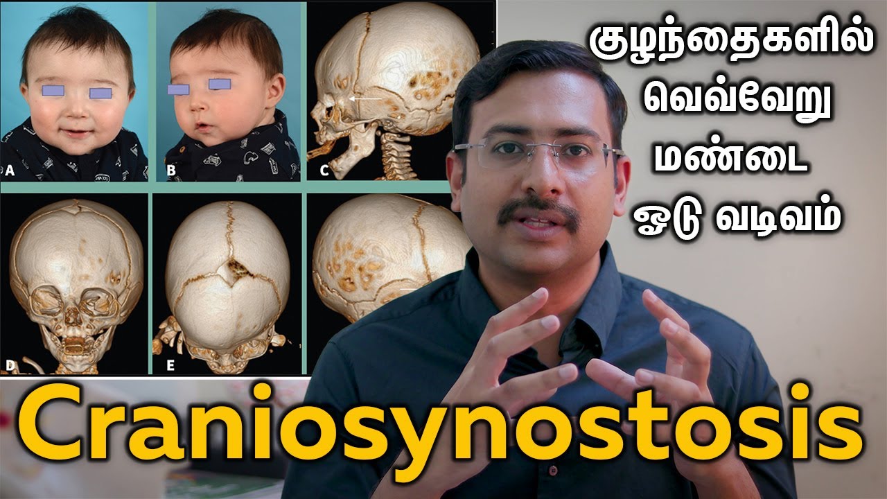 Craniosynostosis| குழந்தைகளில் வெவ்வேறு மண்டை ஓடு வடிவம் |Dr. Hariharasudan Ranganathan