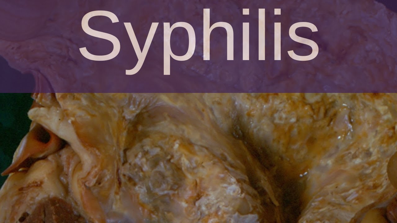 Syphilis - Pathology mini tutorials