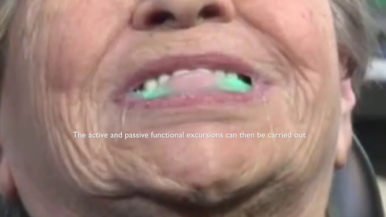 Mucopren Soft Relining Material.