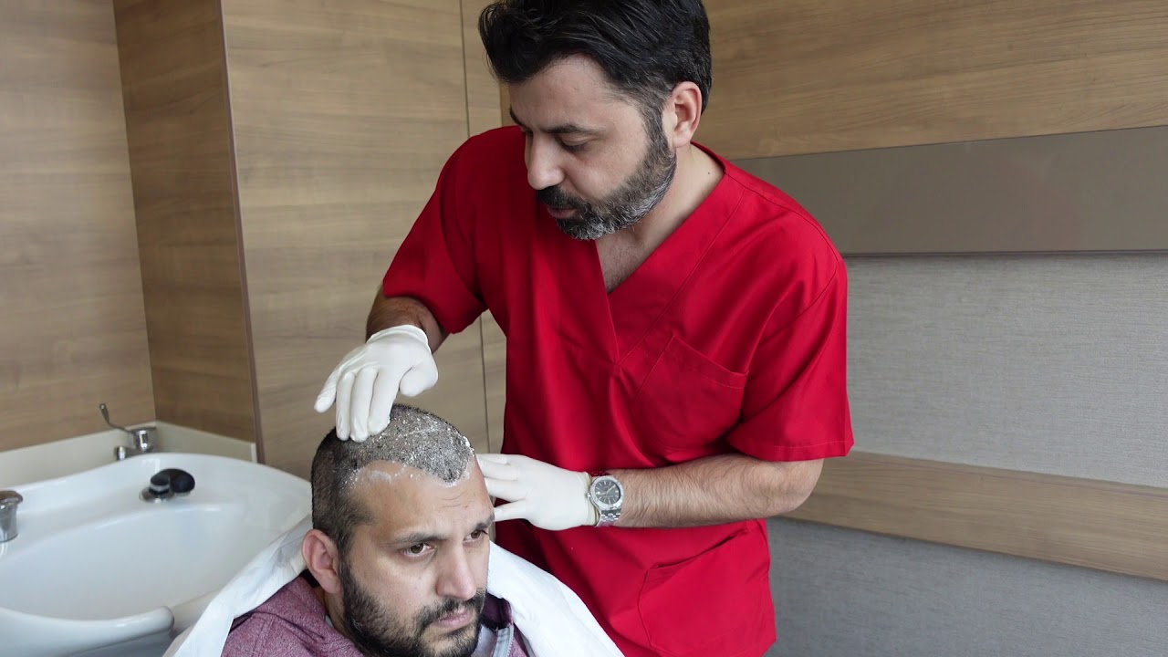 Hair transplant wash after 10 days