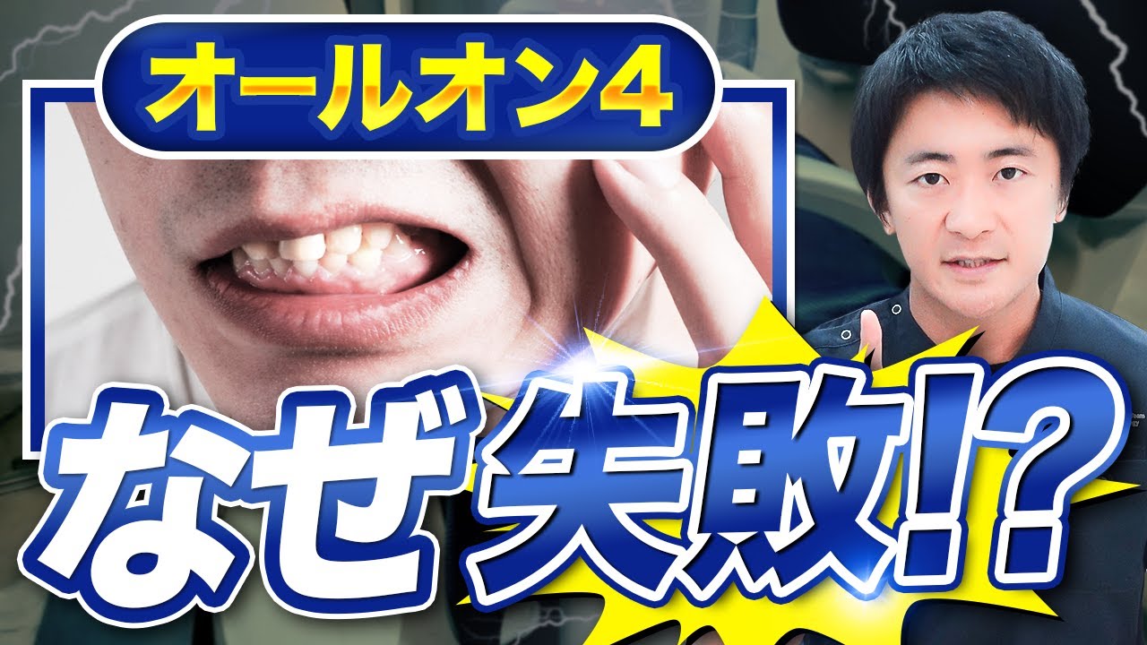 オールオン4なぜ失敗するのか！？歯科医師が解説！！