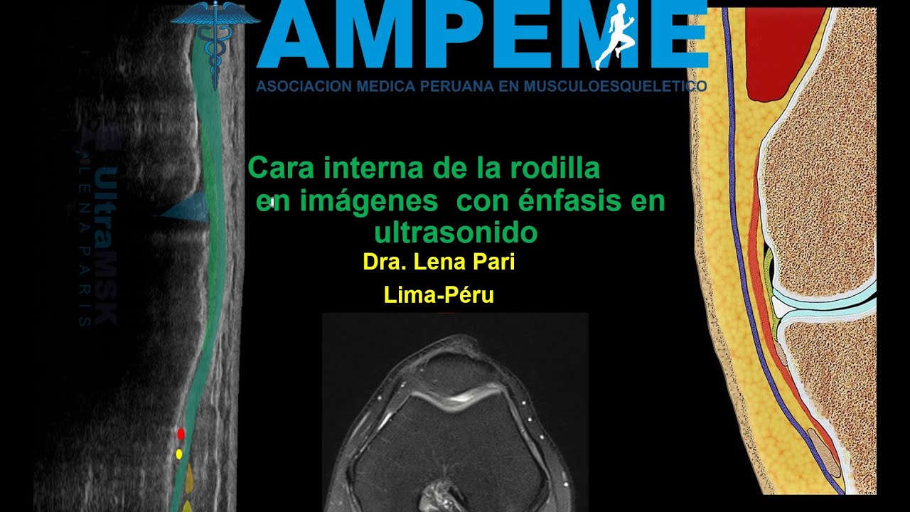 Como evaluar la cara interna de la rodilla en ultrasonido y su correlación con RM. Dra. Lena Pari