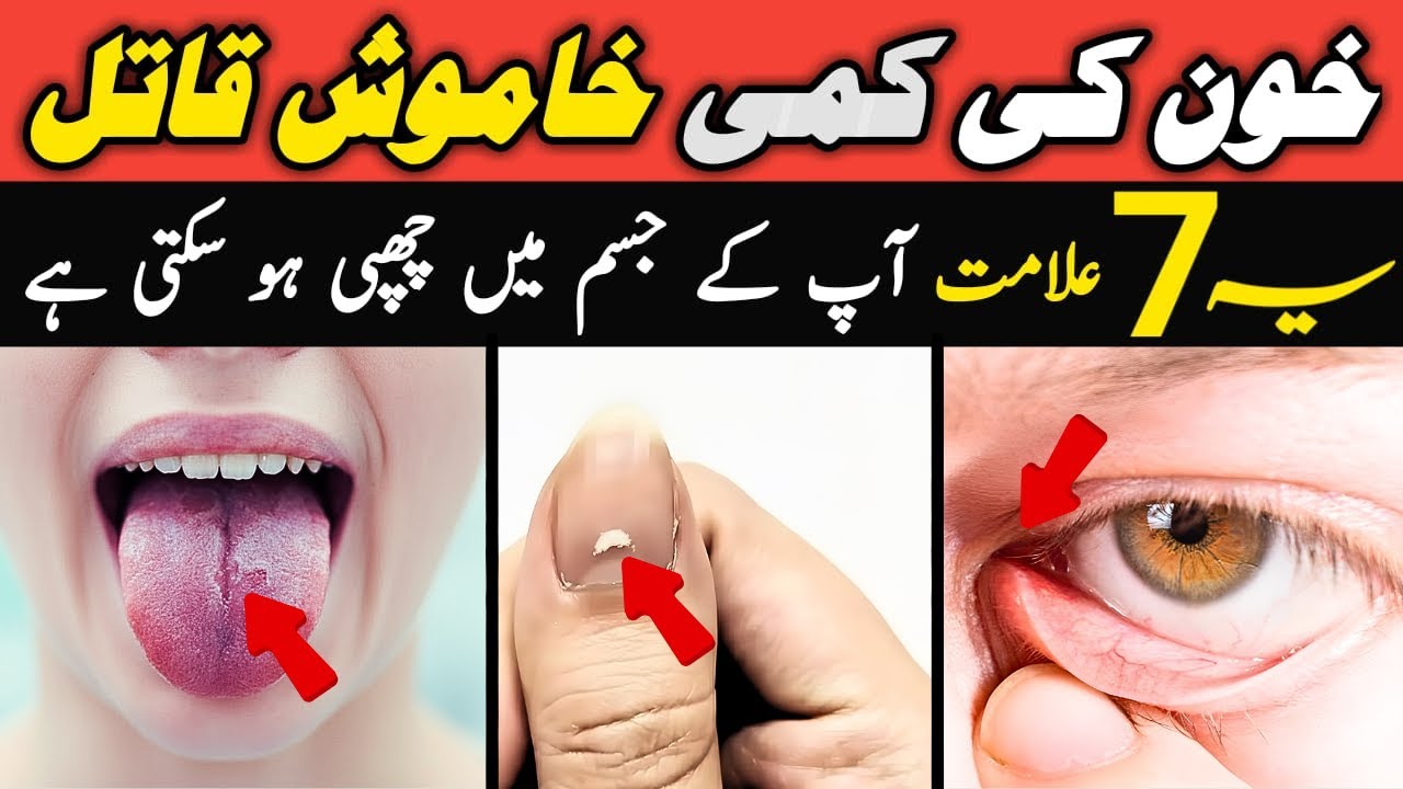 7 Hidden Signs of Iron Deficiency Anemia | Khoon Ki Kami Ki 7 Posheeda Nishaniyan!