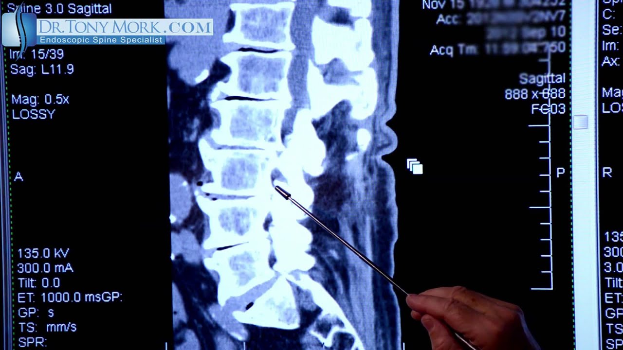 Spondylosis  by Dr. Tony Mork